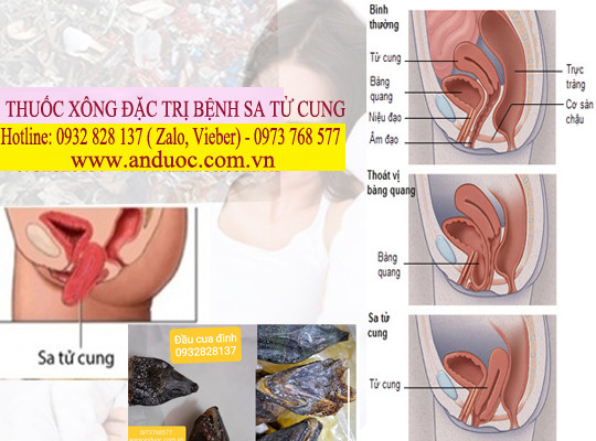 THUỐC XÔNG ĐẦU CUA ĐINH TRỊ BỆNH SA TỬ CUNG
