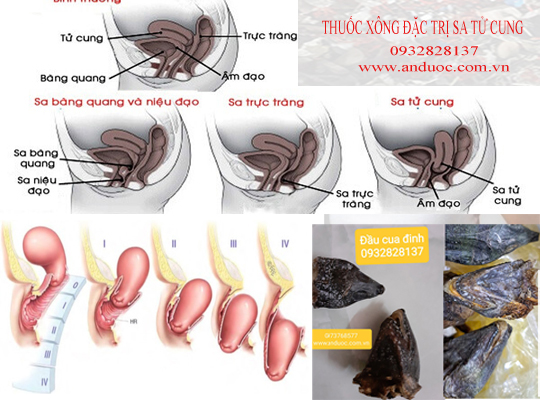 CÁCH XÔNG TRỊ DỨT BỆNH SA TỬ CUNG TẠI NHÀ